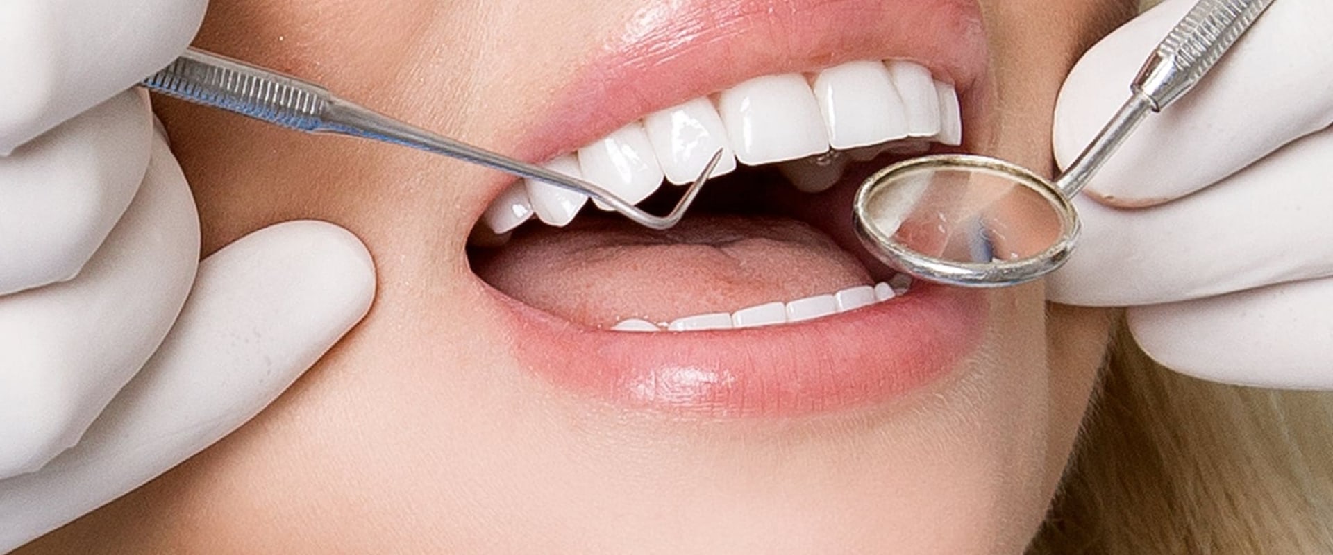 How Long Does it Take to Get Veneers?